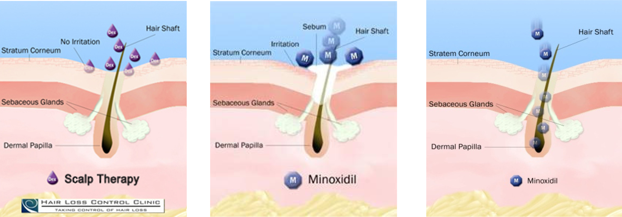 MGT-Maximum Growth | All Natural option to Minoxidil | DHT Inhibitors ...